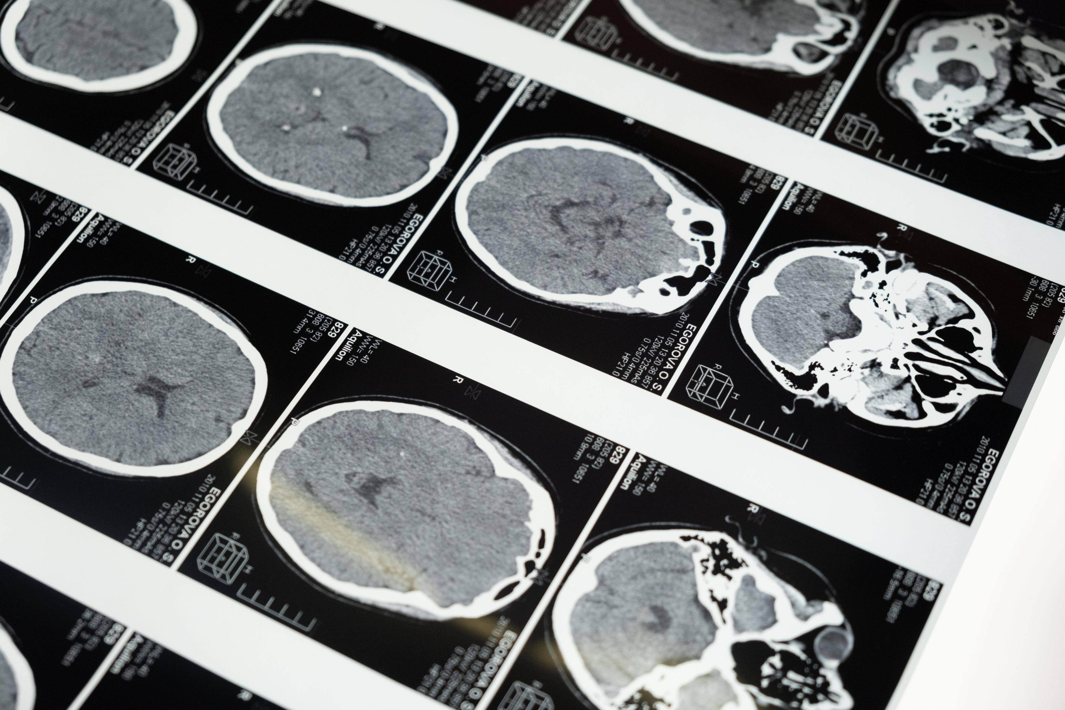 Protocolo NeuroVida — método aplicado